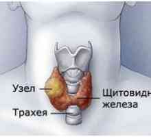 Tratamentul gusa nodulara a glandei tiroide