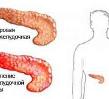 Tratamentul bolilor de droguri pancreasului