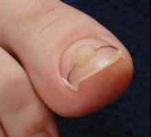 Pentru a trata o unghie incarnata nu este periculos - purta vârful degetului cu unt