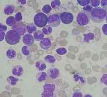 Leucocitele în urină - ce înseamnă? Cauzele de celule albe din sânge în urină.