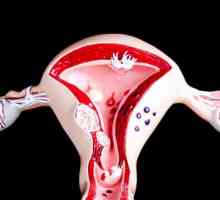 Hemoragie uterină: 23 motive pentru a apela acest proces