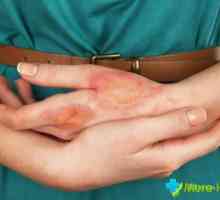 Unguentele de dermatita de pe mâini: cele mai accesibile și eficiente