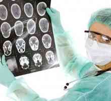 Meningiom Brain: Implicații după o intervenție chirurgicală