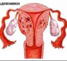 Menstruatie cu adenomioza