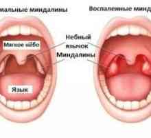 Menstruatie cu angină