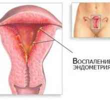 1 Luna la endometrita