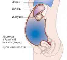 Metode de diagnostic și tratament al ascitei abdominale