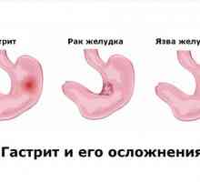 Metodele de tratament al gastritei hipertrofice