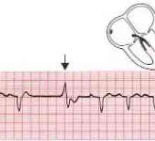 Metode de tratament de aritmii cardiace