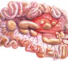 Mesadenitis ca urmare a inflamatiei ganglionilor limfatici