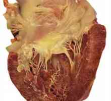 Cardio Myocardio și tratamentul acesteia