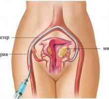 Fibrom uterin (fibroame) fără operație tratate efectiv