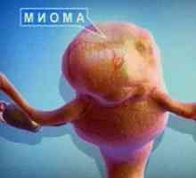 Fibromul uterin - un viclene femei inamice