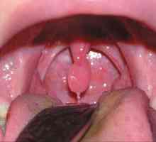 Cele mai frecvente cauze de umflare a limbii în gât