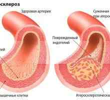 Remedii populare pentru arterioscleroză a extremităților inferioare