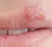 Remedii populare pentru herpes labial