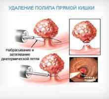 Metodele pentru tratamentul polipozei intestinale