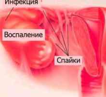 Obstrucționarea trompelor uterine: Simptome si tratament