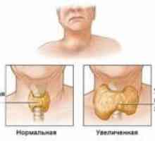 Ce face situația atunci când glanda tiroidă este mărită, iar hormonii sunt normale