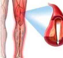 Ateroscleroza a extremităților inferioare (picioare)