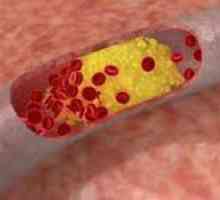 Privire de ansamblu de medicamente care reduc colesterolul din sânge
