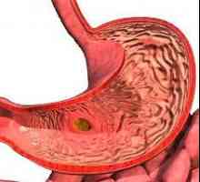 Focal Gastrita - mucozală zona leziunii gastrice