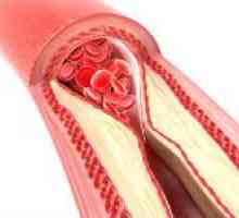 Ocluzia arterelor