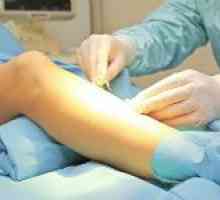 Operațiuni pe venele picioarelor și consecințele lor