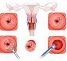 Descrierea procedurii de biopsie de col uterin, în prezența eroziunii. Opinia femeilor, de…