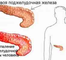 Cum este tratamentul pancreatitei cronice?