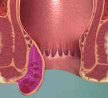 Complicațiile de hemoroizi - tromboză venoasă și flebita: semne, tratamente, efecte