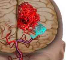 Principalele semne de accident vascular cerebral ischemic