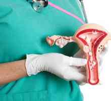 Principalele simptome si tratamentul polipilor endometriali