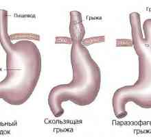 Principalele metode de vindecare herniat stomacului