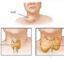 Metodele de bază de tratare a remedii populare gușă tiroidiană