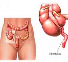 Caracteristici apendicectomie la bărbați și băieți