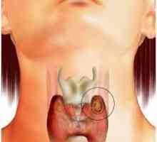 Caracteristici de tratament de chisturi tiroidiene
