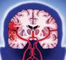 Accident vascular cerebral creier