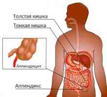 Caracteristici speciale ale apendicita cronica