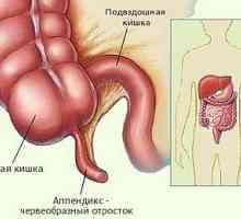 Caracteristici ale dezvoltării de apendicita la copii