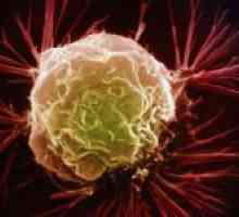Caracteristici de leucemie cu celule păroase