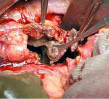 Pancreatită acută: o altă boală din carne și alcool