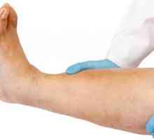 Umflarea picioarelor oamenilor: cauzele, tratamentul si prevenirea