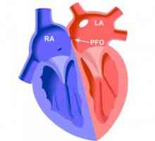Foramen ovale patent (gaura) in inima, cauzele de închidere a prognozei