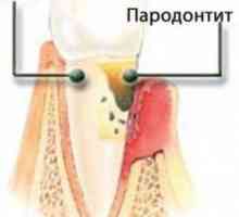 Parodontita - cauze și soluții la problemele