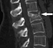 Fractură a coloanei vertebrale toracice