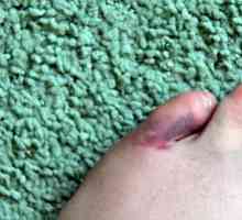Fractura degetului mic de la picior: simptome și tratament