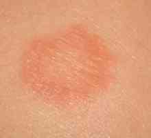 Petele de pe piele, cum ar fi arsuri: posibile cauze