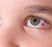 Principalele motive pentru vasele de sânge izbucni în ochi