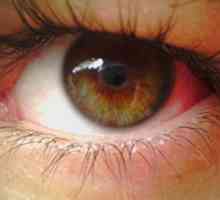 De ce izbucni capilarele în ochi? Cauze și prevenirea